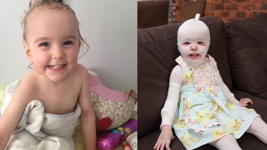 Monroe Mills is still as bubbly as ever, despite a chronic disability. She is pictured both with and without clothing aimed to lessen her condition