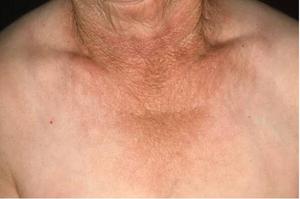 This 70-year-old has deep wrinkling and skin darkening caused by long-term sun exposure on her neck and part of her chest exposed by her shirt, while the rest of her skin has stayed relatively clear and unwrinkled. Author provided
